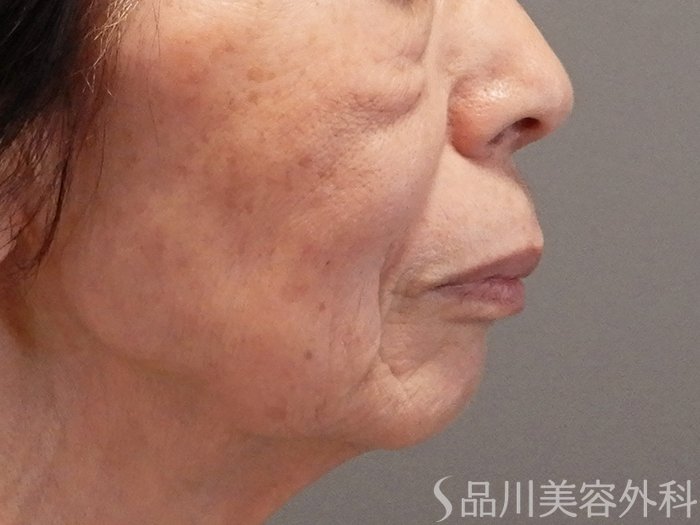 症例NO.70287のBEFORE写真