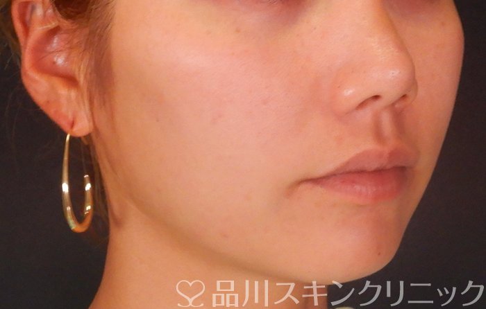 症例NO.65149のAFTER写真