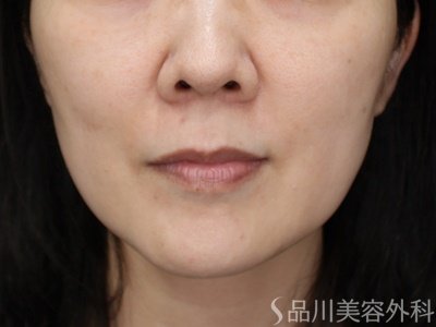 症例NO.71343のBEFORE写真