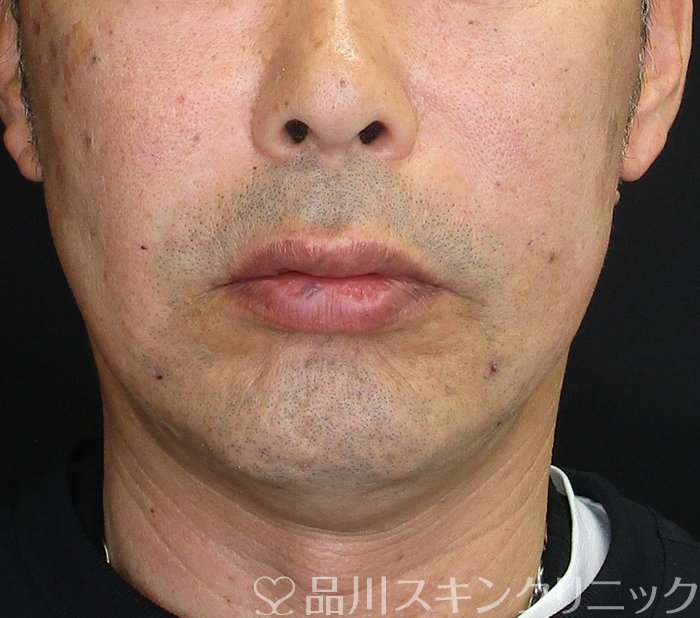症例NO.74111のAFTER写真