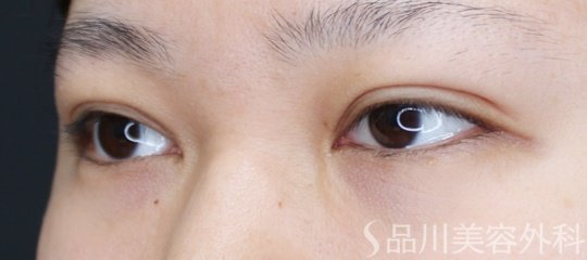 症例NO.72181のAFTER写真