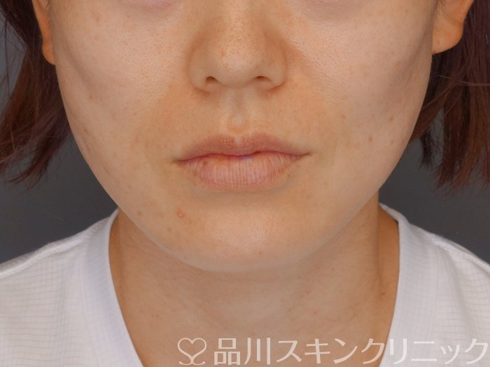 症例NO.71678のAFTER写真