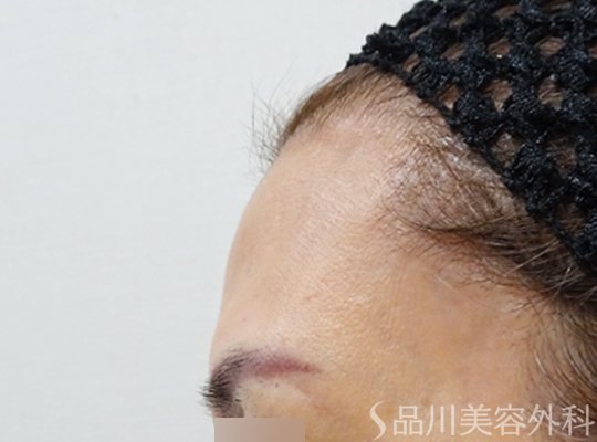症例NO.71841のBEFORE写真