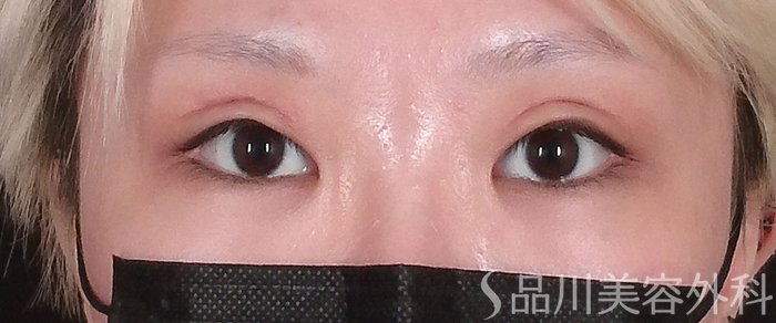 症例NO.70952のAFTER写真