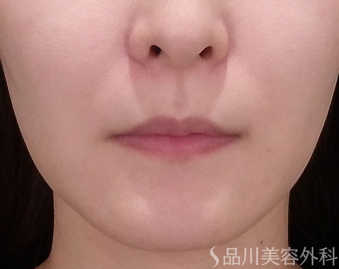 症例NO.70729のBEFORE写真