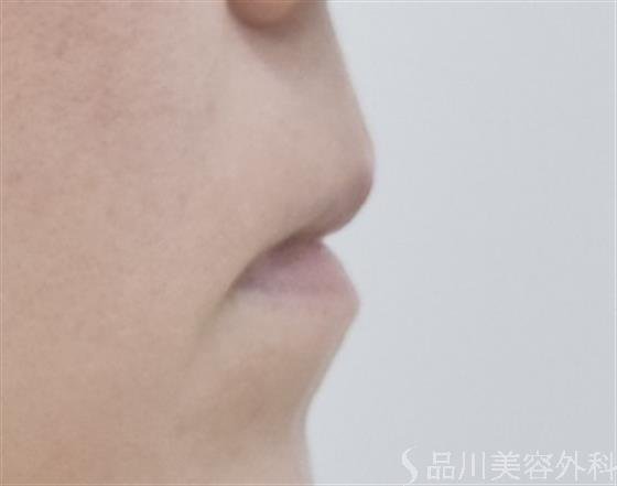 症例NO.52004のBEFORE写真
