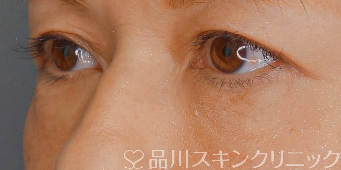 症例NO.71191のAFTER写真