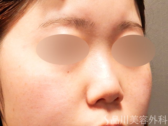 症例NO.69913のBEFORE写真