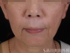 症例NO.72357のBEFORE写真