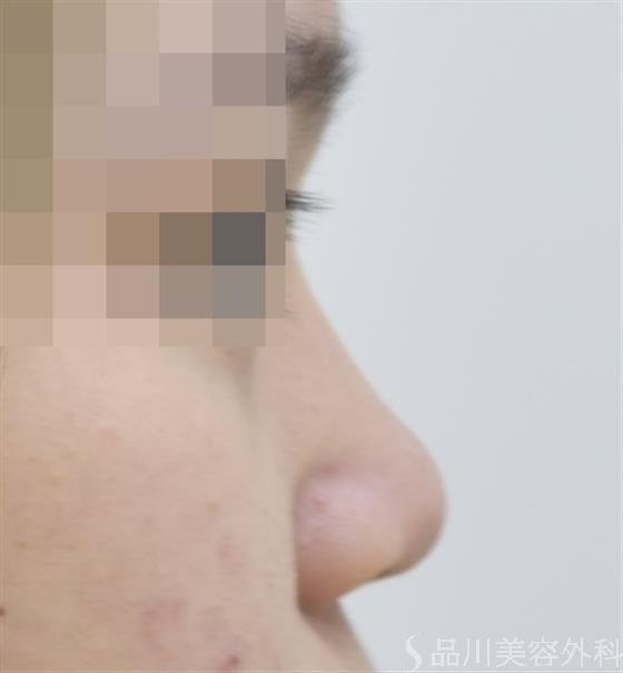 症例NO.46180のBEFORE写真