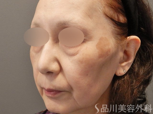 症例NO.74542のBEFORE写真
