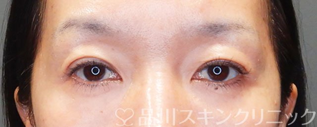 症例NO.75243のAFTER写真
