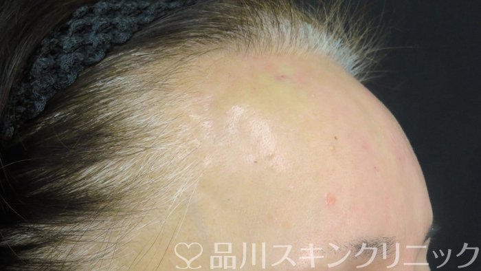 症例NO.74766のAFTER写真