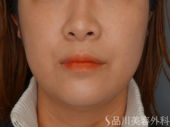 症例NO.73679のAFTER写真