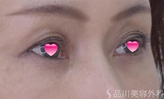 症例NO.50257のAFTER写真