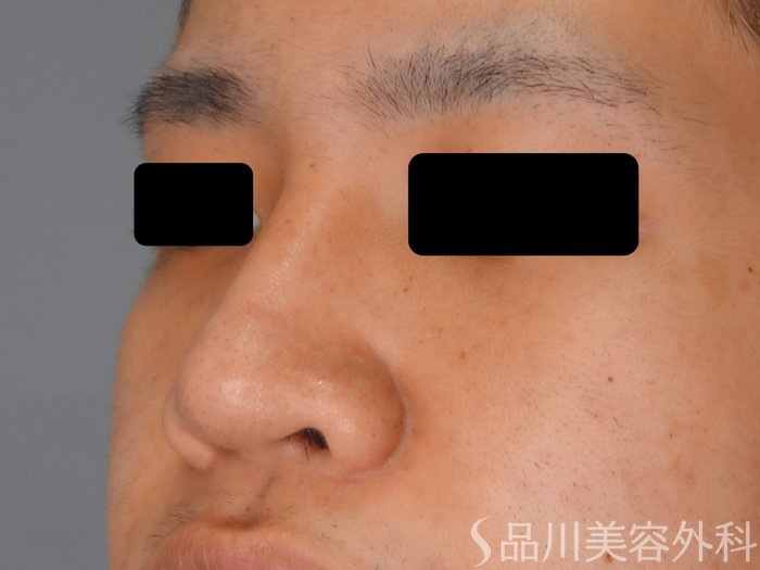 症例NO.75050のAFTER写真