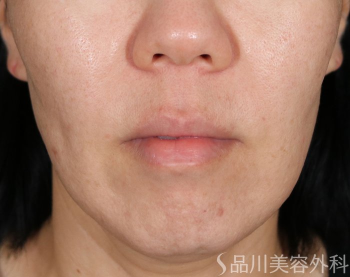 症例NO.70847のBEFORE写真
