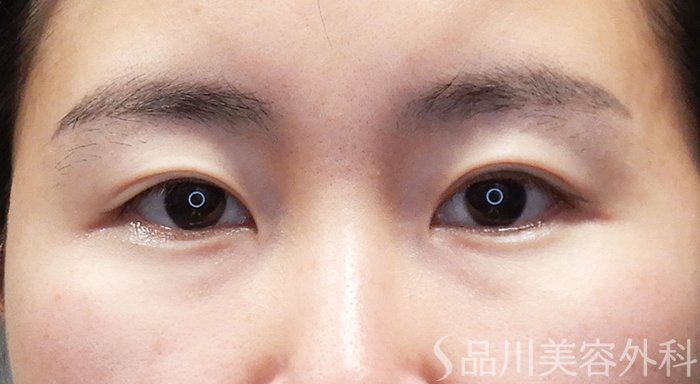 症例NO.69335のBEFORE写真
