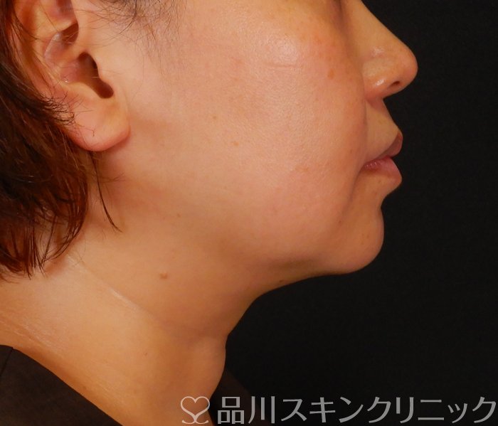 症例NO.66910のAFTER写真