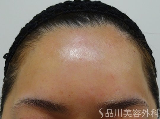 症例NO.72380のAFTER写真