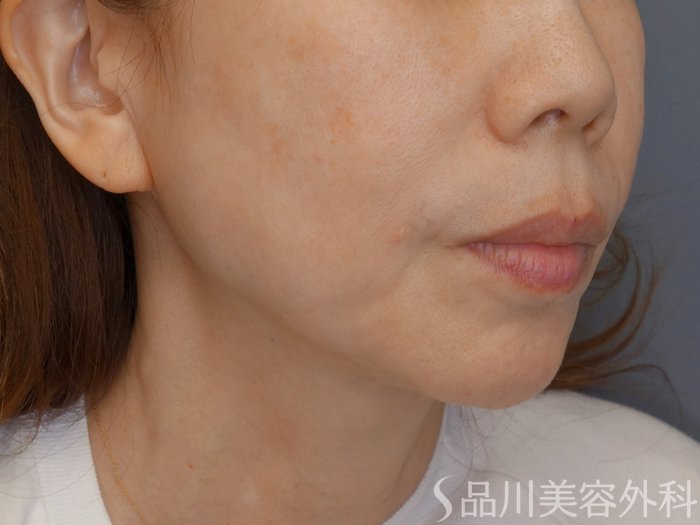 症例NO.71619のBEFORE写真