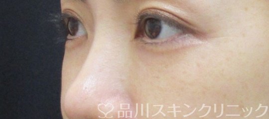 症例NO.74796のAFTER写真