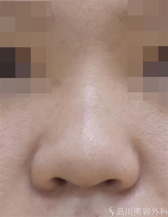 症例NO.48943のBEFORE写真