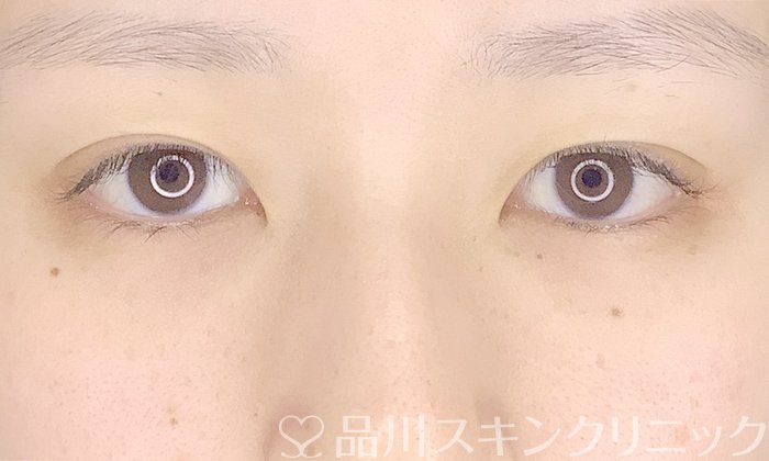 症例NO.69611のAFTER写真