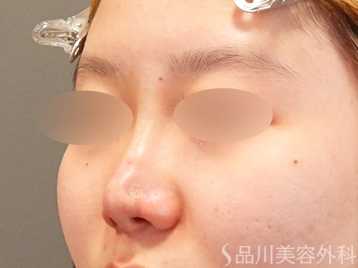 症例NO.70150のAFTER写真