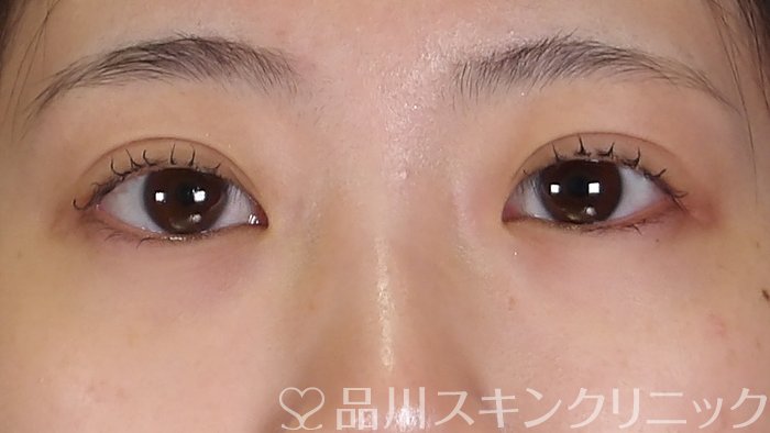 症例NO.69209のAFTER写真
