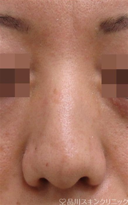症例NO.37025のBEFORE写真