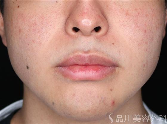症例NO.61890のBEFORE写真