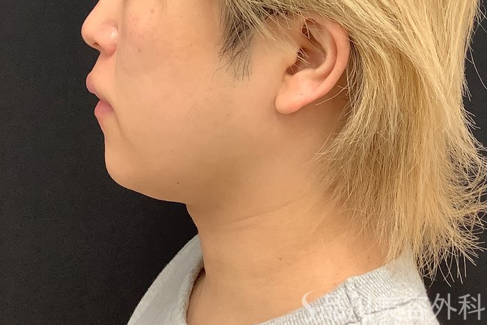 症例NO.75333のBEFORE写真