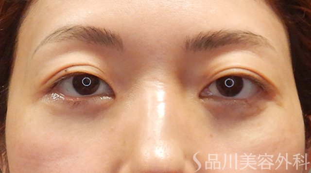 症例NO.73999のAFTER写真
