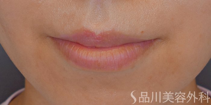 症例NO.71350のBEFORE写真