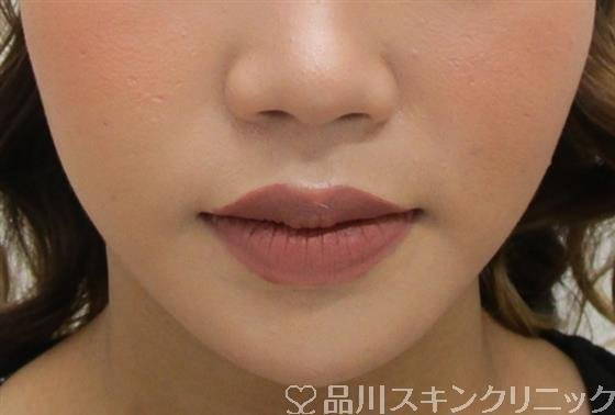 症例NO.39180のAFTER写真