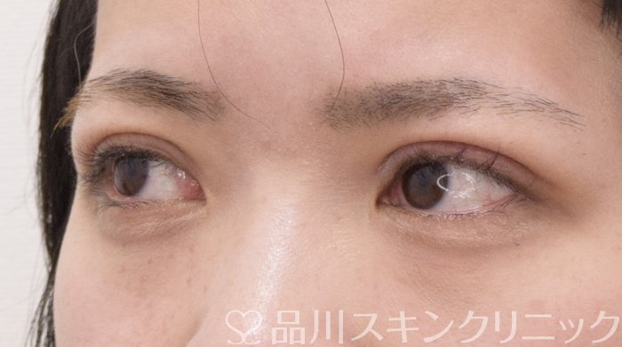 症例NO.71183のAFTER写真