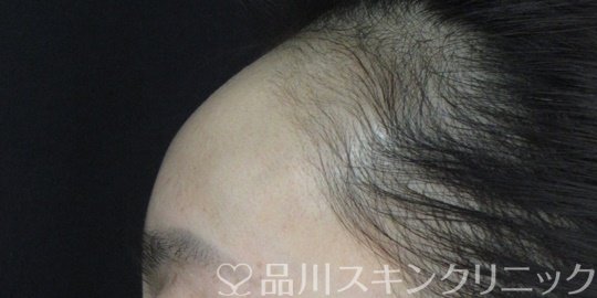 症例NO.74829のBEFORE写真