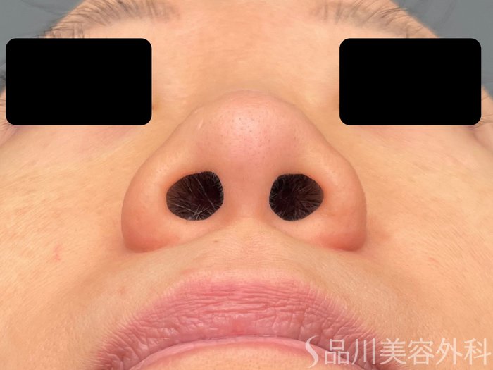 症例NO.72343のBEFORE写真