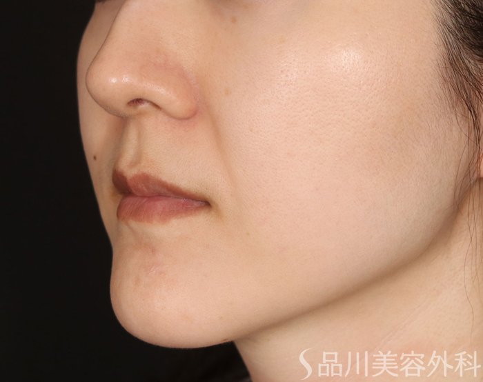 症例NO.71748のBEFORE写真