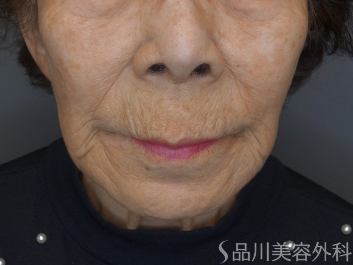 症例NO.74334のBEFORE写真