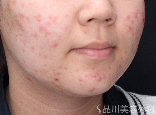 症例NO.73292のBEFORE写真