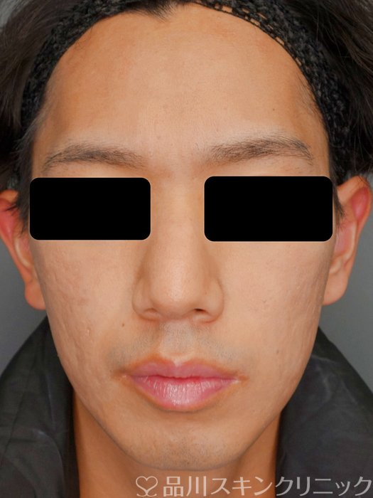 症例NO.73214のAFTER写真