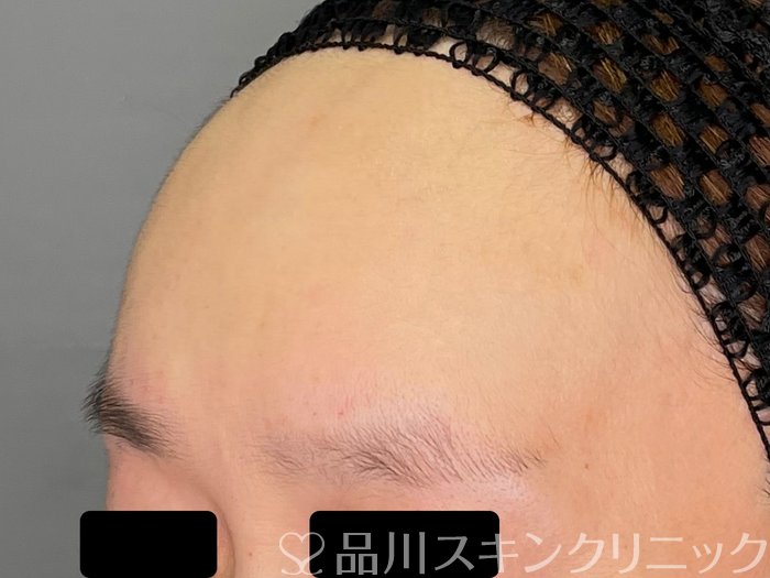 症例NO.70130のAFTER写真