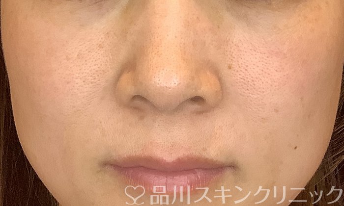 症例NO.73718のBEFORE写真