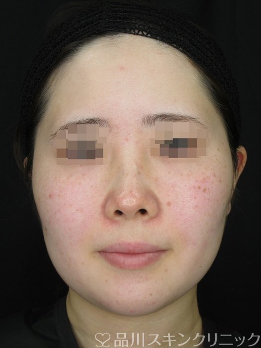 症例NO.71086のBEFORE写真