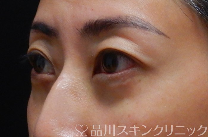 症例NO.67501のAFTER写真