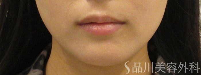 症例NO.72714のBEFORE写真