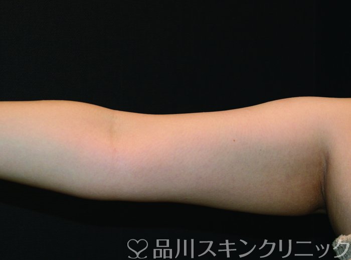 症例NO.72457のAFTER写真