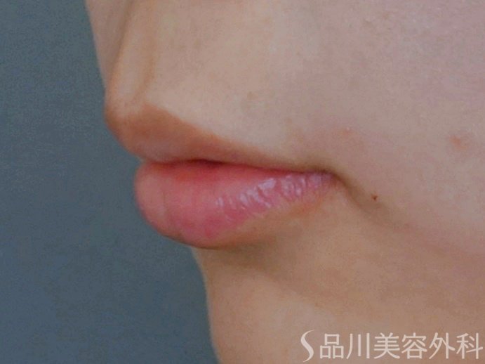 症例NO.73922のAFTER写真